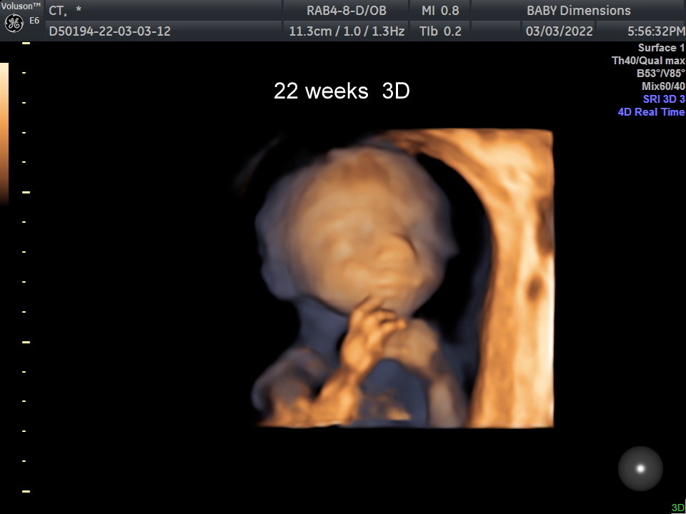 4D Live Ultrasound
