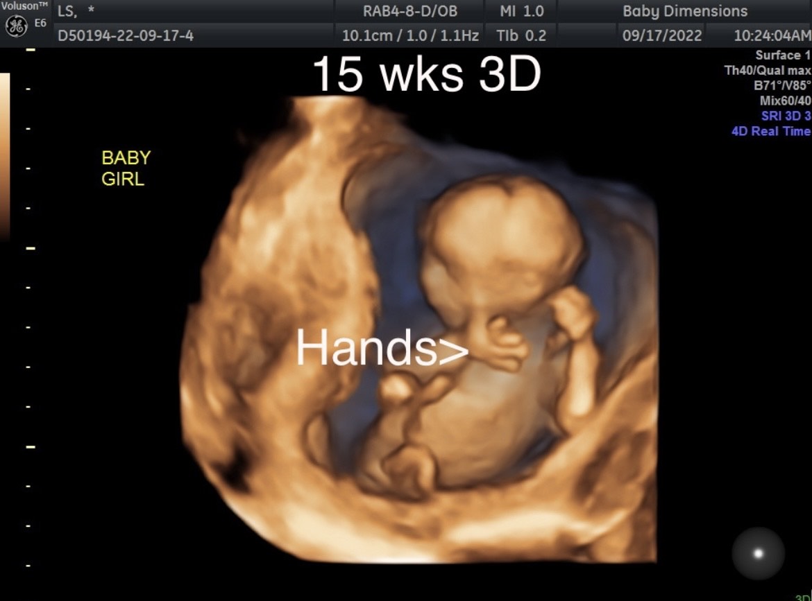 4D Live Ultrasound