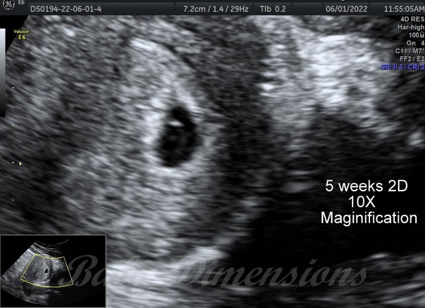 5 pictures, ultrasound, baby, pregnancy